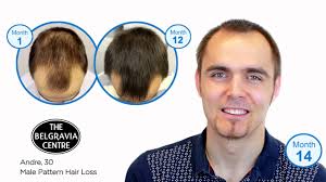 However, hair implants cost a ton and i have 2 small children and a husband on a low paid job. Watch Video Testimonials From Belgravia Centre Hair Loss Treatment Clients
