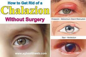 Pin On Home Remedy For Eyes