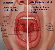 Bacterial Vs Viral Tonsillitis Treatment For Sore Throat Nursing Tips Viral Sore Throat