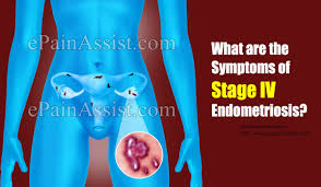 Common signs and symptoms of endometriosis include: What Are The Symptoms Of Stage Iv Endometriosis And Its Treatment Options