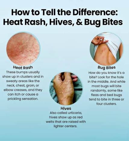 Hives, heat rash, and bug bites can look alike — but the care is different.  Learn the clues to spot which is which in this quick slideshow