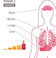 But even though it's moved to other organs, it still behaves like. Stage 4 Iv National Breast Cancer Foundation
