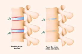Espondilite anquilosante: o que é, causas, sintomas e tratamento – Dr.  Henrique Noronha