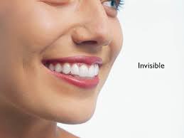 Luckily, there are other ways to straighten your teeth without getting braces fitted; Invisible Braces Invisalign Dr Hassan El Awour S Dental Office