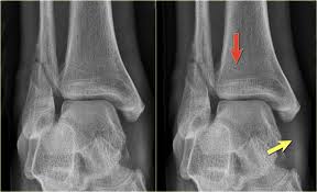 It describes ankle fracture classification, ankle fracture dislocation. The Radiology Assistant Weber And Lauge Hansen Classification