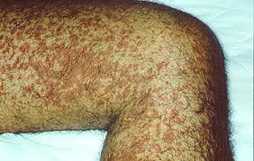Senile purpura is a condition that impacts the elderly and is referred to in many different ways. Symptoms Of Vasculitis Johns Hopkins Vasculitis Center