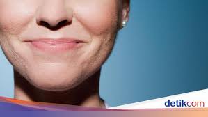 Bell's palsy affects 1 in 5,000 people each year in the united states, and 1 out of 70 throughout a lifetime. Kedutan Di Wajah Gejala Penyakit Als Dan Bell S Palsy Ini Kata Dokter