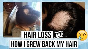 Alopecia hair loss treatment was made from nature's herbs and was cautiously brewed for about ninety days for the nutrients to combine. My Alopecia Areata Story Hair Loss Products I Used To Grow My Hair Back Youtube