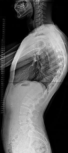 هل الجدب أخطر من اعوجاج العمود الفقري وحده؟