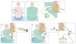 Image result for Thoracentesis