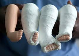 Club foot treatment, photos, images, symptoms, causes. Children S Clubfoot Treatment Causes Pediatric Foot Ankle
