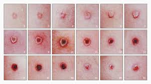 Image result for Smallpox