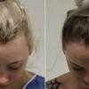 Rambut rontok dalam dunia medis disebut sebagai alopesia. 1