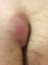 Here are a few ingrown hair treatment products to try because of how effectively. Pilonidal Disease Wikipedia