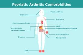 We all know how frustrating it can be to have an itch that just won't stop itching. Psoriatic Arthritis Comorbidities What Patients Need To Know