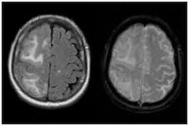 It was developed by biogen inc., which licensed the drug candidate from neurimmune, its discoverer. Amyloid Related Imaging Abnormalities Wikipedia