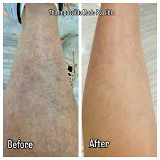 Image result for liver spots on legs