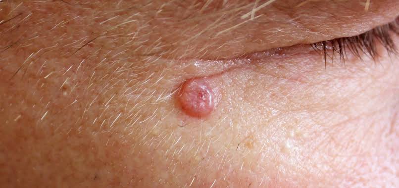 New Therapy Shows Promise for Treating Basal Cell Carcinoma with TVEC ...
