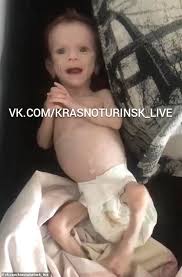 Emaciated meaning, definition, what is emaciated: Emaciated Girl Is Rescued In Russia After Being Left In A Closet By Her Mother To Starve