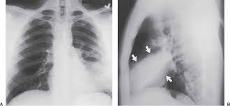 In left upper lobe collapse, the superior segment of the left lower lobe, which is positioned between the aortic arch and the collapsed left upper lobe, is. Signs And Patterns Of Lung Disease Radiology Key