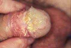 If we talk about a small amount of smegma, then this is considered a variant of the norm. What S Normal East Sussex Sexual Health
