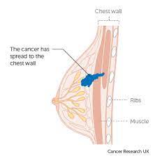 Although it is the most commonly diagnosed cancer in american women, breast cancer can impact people of all genders. Stage 3 Breast Cancer Cancer Research Uk