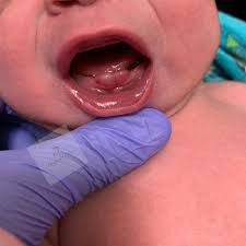 Image result for Neonatal Teeth