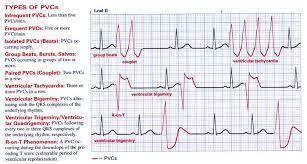 Premature Ventricular Cardio Cardiovascular World Facebook Raising funds for those in need through 350 op shops & our online store. premature ventricular cardio