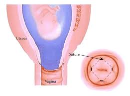 Image result for Recurrent Miscarriage