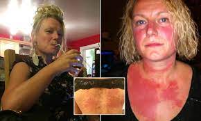 Can you really be allergic to alcohol? The Former Party Animal Who Is Now Allergic To Alcohol Mother 42 Quits Drinking After Reaction Daily Mail Online