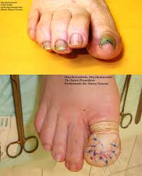 Image result for Clubbing nails feet