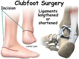 While it is next to impossible. Physical Therapy In Plymouth For Pediatric Issues Clubfoot