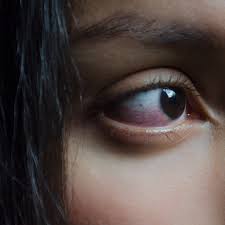 Eyebright, fennel seed, rue, chamomile flower, goldenseal root. What Exactly Causes Red Eyes That Look All Bloodshot Self