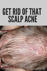 How To Get Rid Of Scalp Acne Pimples On Scalp Scalp Acne Itchy Scalp Remedy