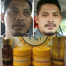 Merawat masalah jerawat parah dan menghilangkan parut. Bee Venom Skin Care Testimoni Bee Venom Skincare Review