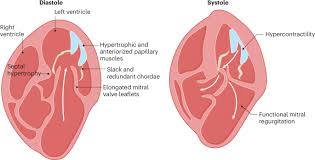 Image result for Cardiomyopathy