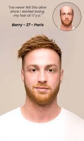 Make your front hairline perfect natural looking! Non Surgical Hair Replacement Systems Onehead Hair Solutions
