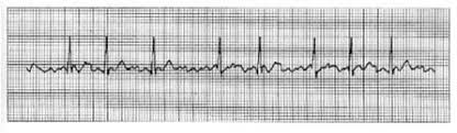 Basic, advanced cardiac life support, pediatric advanced life support , neonatal nrp Acls Pre Test 2019 Flashcards Quizlet
