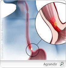 Le cancer de l'estomac, ou cancer gastrique, est une tumeur maligne prenant naissance dans les cellules de on peut toutefois reconnaître un cancer gastrique aux signes cliniques suivants Cancer De L Oesophage Symptomes