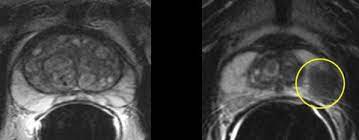 This trial focused on the accuracy of mri for staging prostate cancer in men with clinically localized disease and who had radical prostatectomy. All For One A Belgian Prostate Unit At Work Healthcare In Europe Com