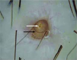 Gongylonema pulchrum is the only parasite of the genus gongylonema capable of infecting humans. Dermatobia Hominis An Overview Sciencedirect Topics