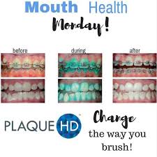 Start moving the brush in circular motions around your braces and teeth. Pin On Cool Stuff For Braces N Teeth