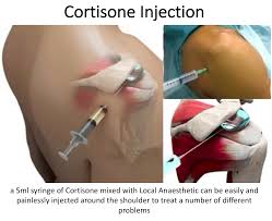 Image result for Shoulder Injection