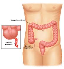 The appendix is attached to the posterior abdominal wall by the mesoappendix. Appendectomy Scl Health