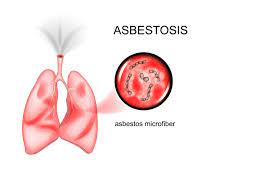 Information is a powerful weapon against uncertainty and fear, and you can use this to your advantage. Can Asbestos Cause Lung Nodules Lung Cancer Lawsuit Lawyers Pintas Mullins Law Firm