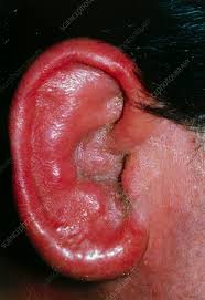 Image result for Acute Otitis Externa