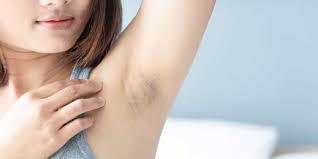 Bu videomuzda koltuk altındaki sarı lekeler nasıl temizlenir bulabilirsiniz. Koltuk Alti Kararmasi Neden Olur Dogal Tedavi Yontemleri Nelerdir