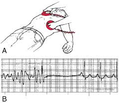 The shock paddles (defibrillator) are used when the patient is in one of those rhythms. Defibrillation Definition Of Defibrillation By Medical Dictionary