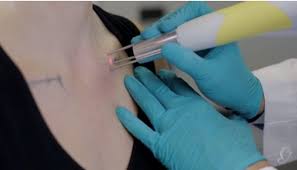 Its location on your body. Top 10 Best Tattoo Removal Laser Machines Reviews Guides 2021 Guy Leta Tooer