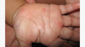 Image result for Hand foot and mouth disease HFMD roof of mouth